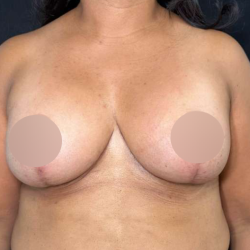 Breast Lift Before & After Patient #718