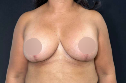 Breast Lift Before & After Patient #718
