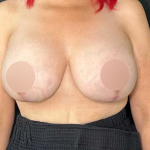 Breast Lift Before & After Patient #727