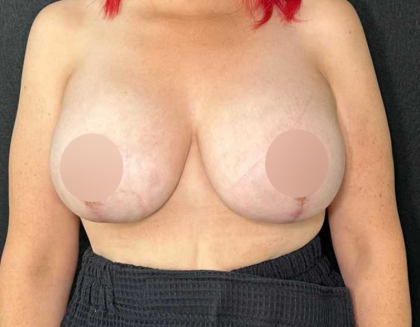 Breast Lift Before & After Patient #727