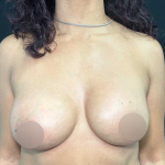 Breast Lift Before & After Patient #566