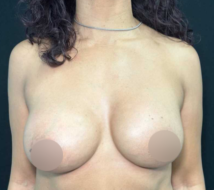 Breast Lift Before & After Patient #566
