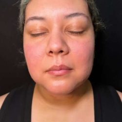 Chin Lipo Before & After Patient #779