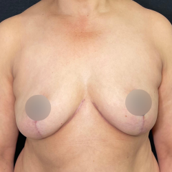 Breast Lift Before & After Patient #569