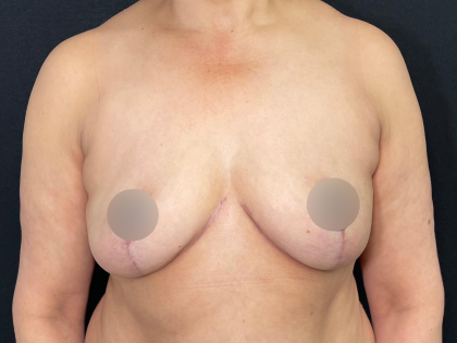 Breast Lift Before & After Patient #569