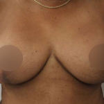 Breast Lift Before & After Patient #578