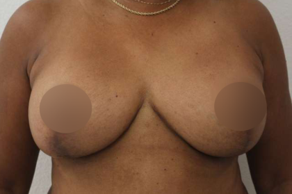 Breast Lift Before & After Patient #578