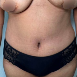 Tummy Tuck Before & After Patient #912