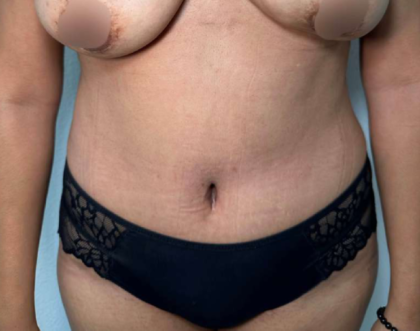 Tummy Tuck Before & After Patient #912