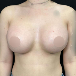 Breast Augmentation Before & After Patient #644