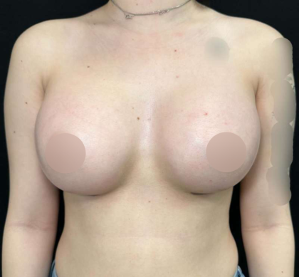 Breast Augmentation Before & After Patient #644