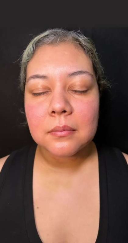 Chin Lipo Before & After Patient #779