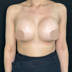 Breast Augmentation Before & After Patient #647