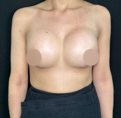 Breast Augmentation Before & After Patient #647