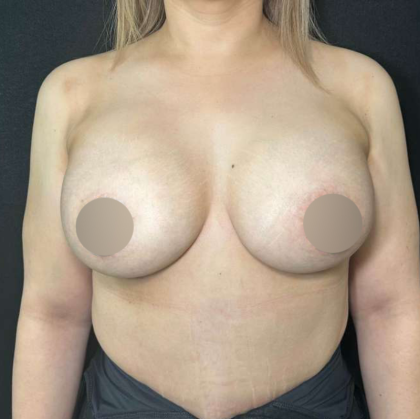 Breast Augmentation Before & After Patient #659