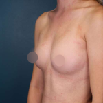 Breast Augmentation Before & After Patient #700