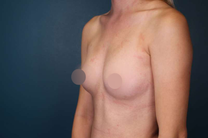 Breast Augmentation Before & After Patient #700