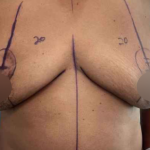 Breast Lift Before & After Patient #578