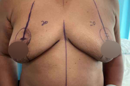 Breast Lift Before & After Patient #578
