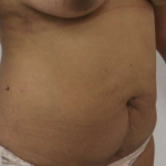 Tummy Tuck Before & After Patient #912