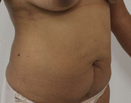 Tummy Tuck Before & After Patient #912