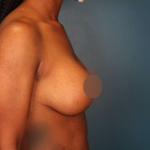 Breast Lift Before & After Patient #752
