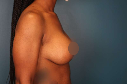 Breast Lift Before & After Patient #752