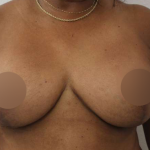 Breast Lift Before & After Patient #578