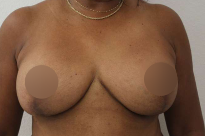 Breast Lift Before & After Patient #578