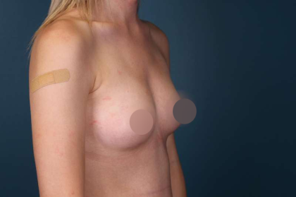 Breast Augmentation Before & After Patient #700