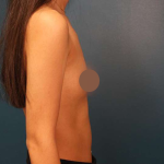 Breast Augmentation Before & After Patient #682