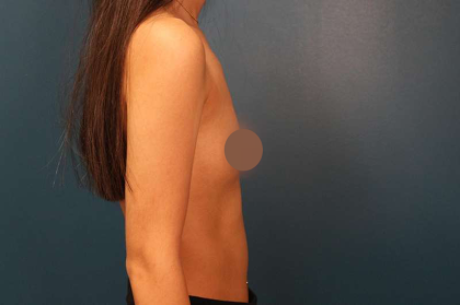 Breast Augmentation Before & After Patient #682