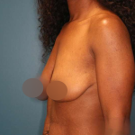 Breast Lift Before & After Patient #752