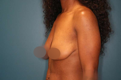 Breast Lift Before & After Patient #752
