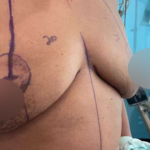 Breast Lift Before & After Patient #578