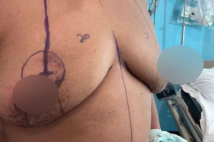 Breast Lift Before & After Patient #578