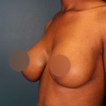Breast Lift Before & After Patient #752