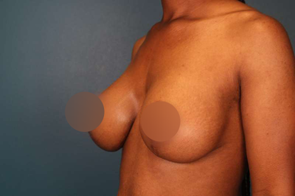 Breast Lift Before & After Patient #752