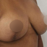 Breast Lift Before & After Patient #578