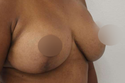 Breast Lift Before & After Patient #578
