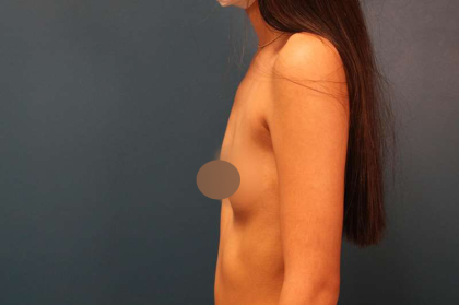 Breast Augmentation Before & After Patient #682