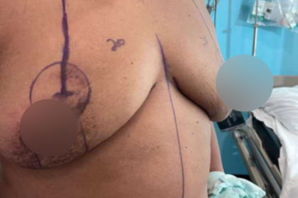 Breast Lift Before & After Patient #578