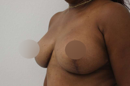 Breast Lift Before & After Patient #578