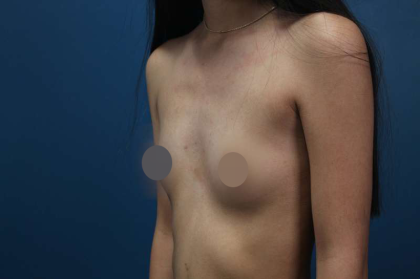 Breast Augmentation Before & After Patient #682