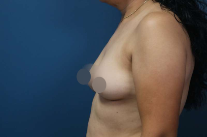 Breast Augmentation Before & After Patient #693