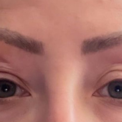 Eyelid Lift Before & After Patient #4440