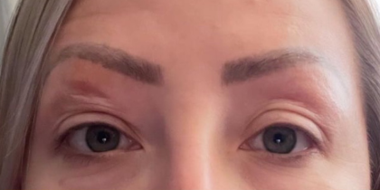 Eyelid Lift Before & After Patient #4440
