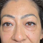 Eyelid Lift Before & After Patient #4434