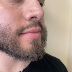 Filler Before & After Patient #4413