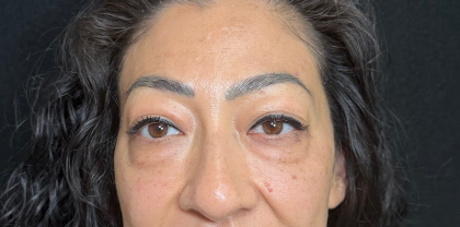 Eyelid Lift Before & After Patient #4434